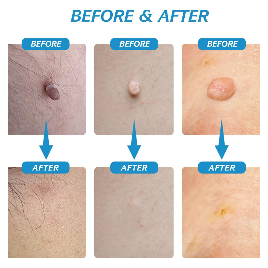 DermaFix™ – Remove Skin Tags Safely at Home